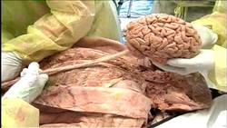 Não bộ và tủy sống - Hệ thần kinh trung ương